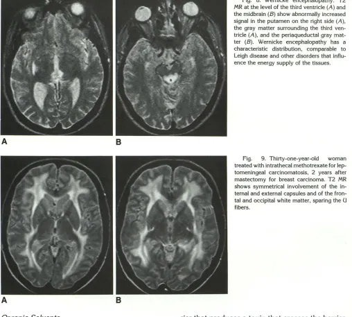 Fig. 8. Wernicke MR signal in the tricle the the gray ence the energy characteristic distribution, comparable ter (B)