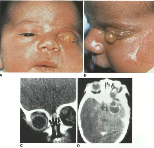 Fig. 15. Orbital teratoma. c A, B, 