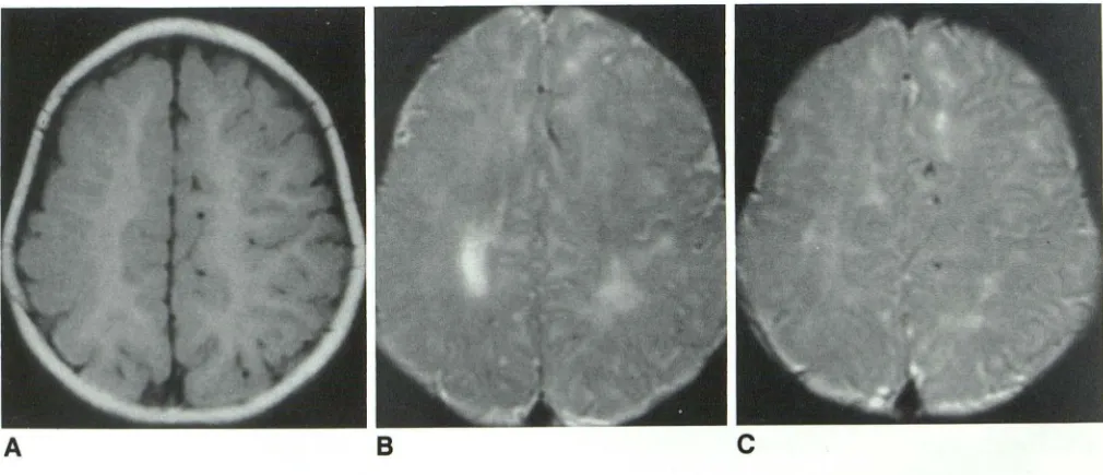 Fig. 3 Diffuse atrophy A, consistent with perinatal asphyxic event in patient born at term (case 20)