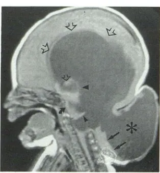 TABLE 1: Imaging features of Chiari III malformation 