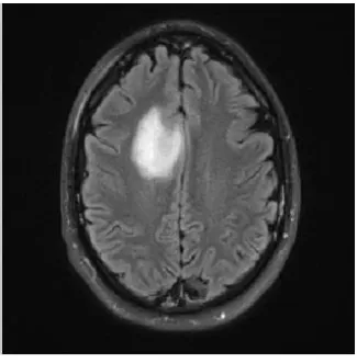 Figure 2. An example of Brain tumor MRI  