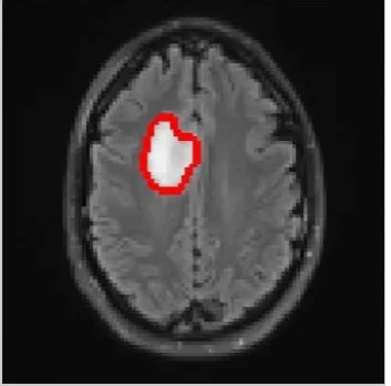 Figure 5 shows an example of tumor segmentation result. The result obtained through this method is compared with the segmentation result obtained through multi-fractal analysis