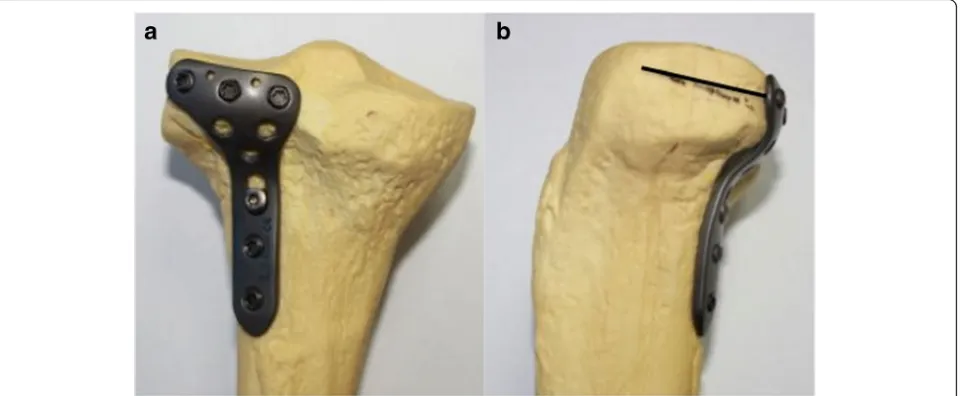 Fig. 1 The newly designed posterolateral anatomic locking plate which is specially used in posterolateral tibial plateau fracture