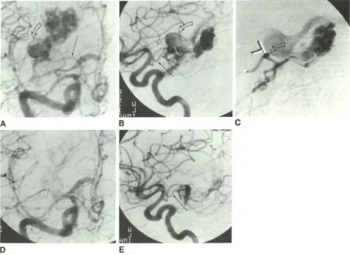 Fig. 2.-Case (arrow)choroidal artery shunting, with preservation artery 8 years prior to current embolization