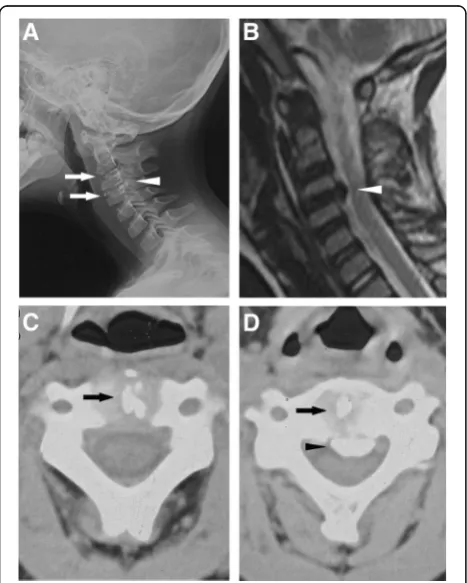 Fig. 1 Radiological imaging at admission.spinal cord was compressed anteriorly at the C3/4 level (arrow).Axial computed tomography through C2/3 revealed IDC (thickarrows) at C2/3.revealed IDC (thick arrows) at C3/4 and OPLL at C3/4 level (thinarrow)