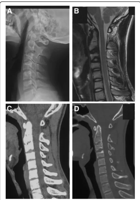 Fig. 3resonance imaging revealed loss of T2-weighted signal intensity ofC2/3 disc and decrease of T2-weighted signal intensity of C3/4 disc.c Computed tomography revealed minor calcification at C2/3intervertebral disc left, IDC and OPLL at the C3/4 level d
