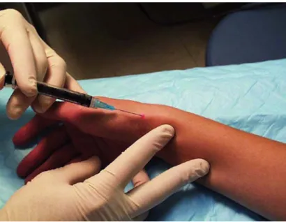 FIGURE 3. Injection for de Quervain’s tenosynovitis. The needle is placed into the first extensor compartment and directed proximally toward the radial styloid.