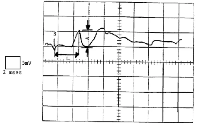 Figure 2.  Sensory response recorded distally.  S represents the stimulus, L represents the latency of the response,  and A represents the amplitude