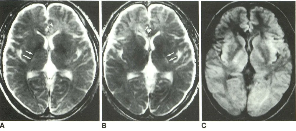 Fig. 6.-Apparent (arrowheads) dependence white matter. The internal A, 8, diffusion coefficient (ADC) maps and the diffusion-weighted image of a healthy volunteer