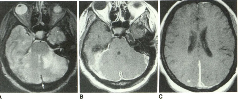 Fig. 1.-Case C, A, B, 4: 29-year-old man with suspected encephalitis. Axial unenhanced T2-weighted image shows nonspecific foci of high signal intensity at gray-white junction (arrows)