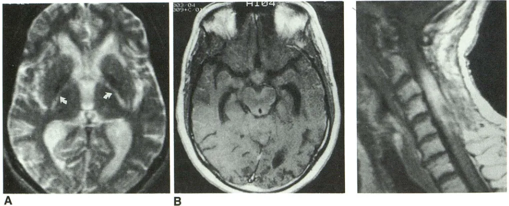 Fig. 8.-Case quadriparesis. weighted image 14: 56-year-old woman with Sagittal postcontrast T1-shows enhancing intramedul-lary mass mimicking a neoplasm