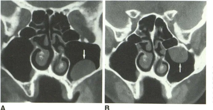 Fig. 1.-A patient prone cous retention age alone, debris has the appearance essary to document that lesion is different locations on within rize abnormality correctly, both images are nec-and 8, Free migrating ball of debris left maxillary sinus (arrows) i