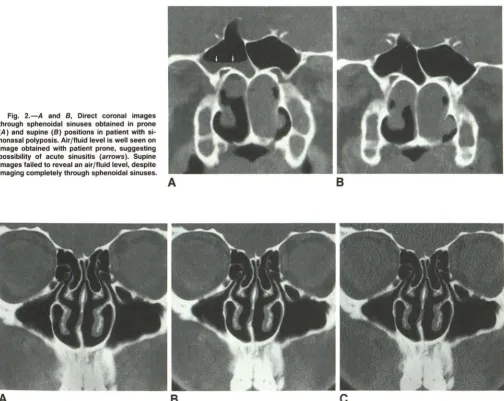 Fig. 2.-A and 8, Direct coronal images through sphenoidal sinuses obtained in prone 