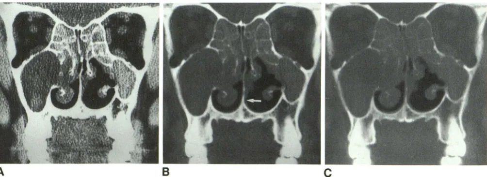 Fig. 4.also v1suahzed accurately 2000 and 250 H -A- C, Single slice, obtained with bone algorithm, photographed at three different window levels and widths, respectively: 450 and 50 H (A), (8), and 4000 and 1100 H (C)