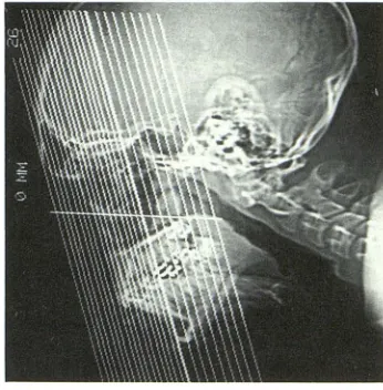 Fig. 5.-A-C, cause A, 8 Dramatic example of usefulness of prescanning preparation of patient
