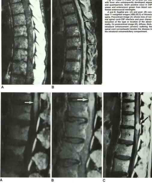 Fig. 2.-Case and quadriparesis. Gram positive smear and enterococci firmed enterococcal meningitis