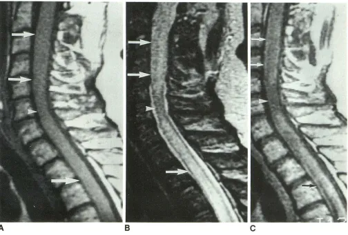Fig. 4.-Case enhancement separated A, 8 8 (Table 4): Inflammatory myelitis in 45-year-old man who presented with chest and abdominal numbness