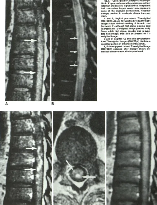 Fig. 5.-Case litis in 3 (Table 4): Herpes zoster mye-41 -year-old man with progressive urinary 