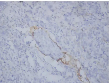 Figure 1. Invasive breast carcinoma showing positive im- munostaining of lymph vessels with D2-40 (100×)