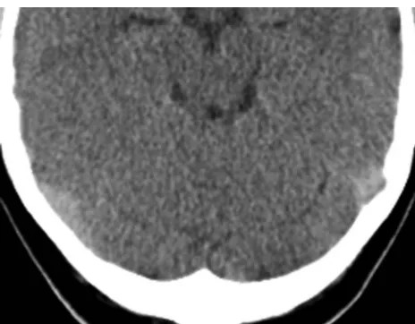 FIG 1. Axial brain CT scan in a patient with false-negative results (left sigmoid sinus according to the measurements of 2 readers [mean HU, 55;HCT, 39.6; H:H ratio, 1.39]).