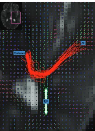 FIG 3. HARDI ﬁber tracks (red) and DTI ﬁber tracks (blue) are visual-ized in the left and right hemispheres