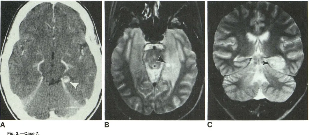 Fig. 2.-Case A, 8 15. Enhanced CT scan shows well-defined hypodense nonenhancing lesion (arrowhead)