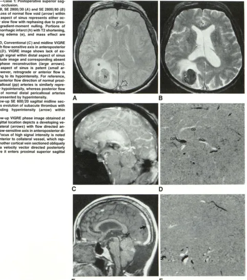 Fig. 3.-Case 1: Postoperative superior sag-ittal sinus occlusion. 