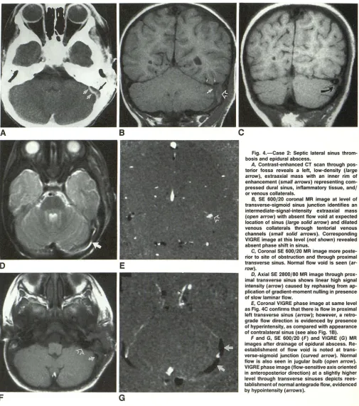 Fig. 4.-Case 2: Septic lateral sinus throm-bosis and epidural abscess. 