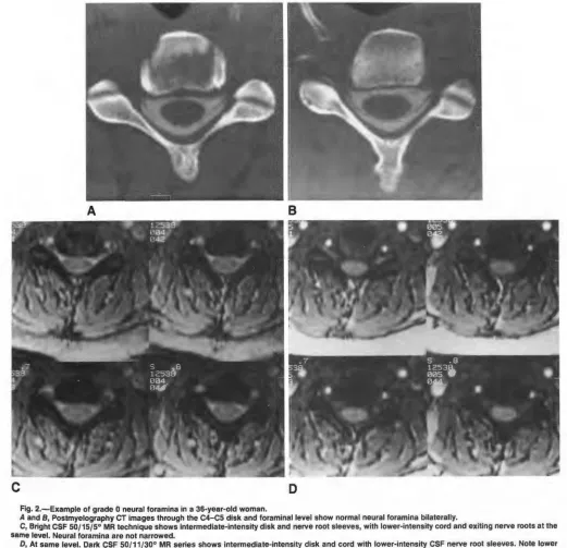 Fig. 2.-Example A of grade 0 neural foramina in a 36-year-old woman. and 8, Postmyelography CT images through the C4-c5 disk and foraminallevel show normal neural foramina bilaterally