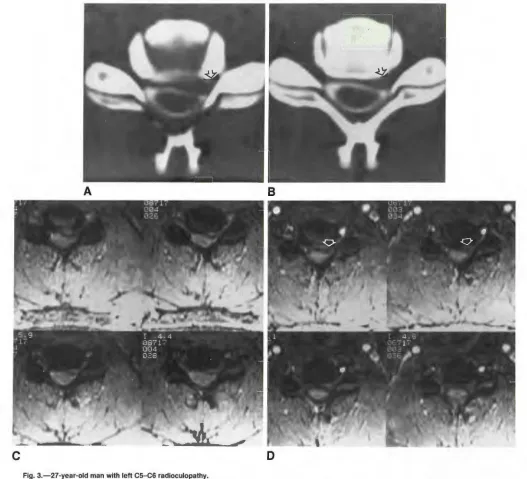 Fig. 3.-27-year-old A man with left C5-C6 radioculopathy. and 8, Postmyelogram CT scans through disk level (A) 