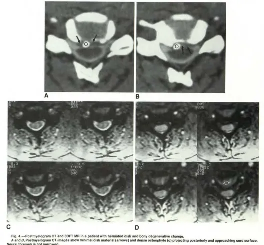 Fig. 4.-A Postmyelogram CT and 30FT MR in a patient with herniated disk and bony degenerative change