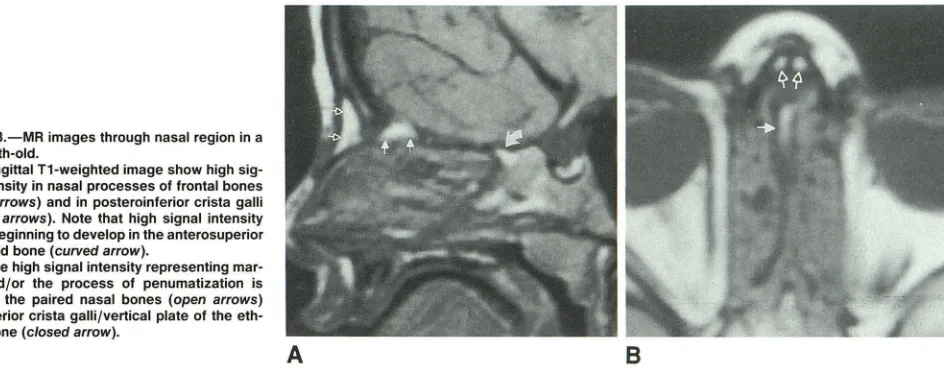 Fig. 2.-Axial does marrow or perhaps early pneumat1zat1on A, C, B, CT scans through nose and cribriform plate region in an 11-month-old