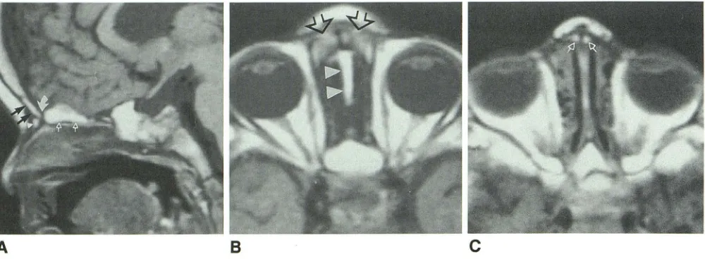 Fig. 4.-MR A, images through cribriform plate region in a 19-month-old child. Sagittal SE 600{20 image shows high signal intensity in nasal processes 