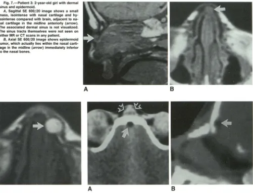 Fig. 7.-Patient 3: 2-year-old girl with dermal sinus and epidermoid. 