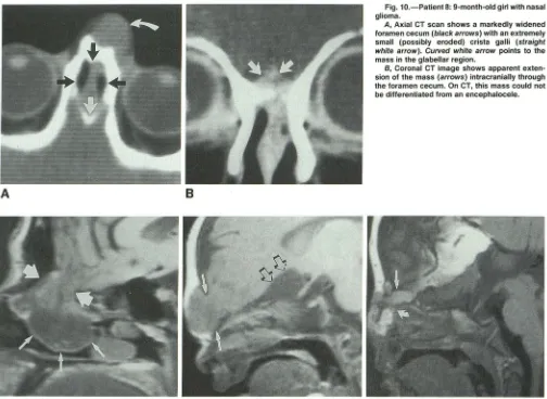 Fig. 10.-Patient 8: 9-month-old girl with nasal glioma. 