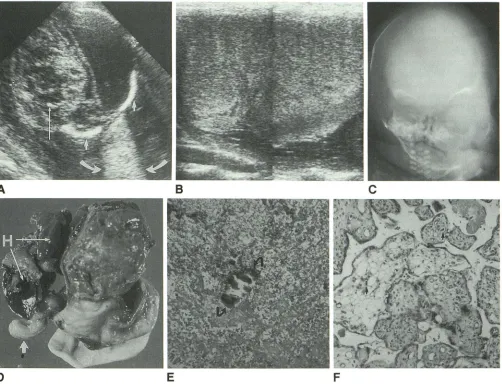 Fig. focus of of edematous villi with dilated blood hematopoietic elements (arrows), including many nucleated RBCs, are seen as sound beam right cerebral hemisphere