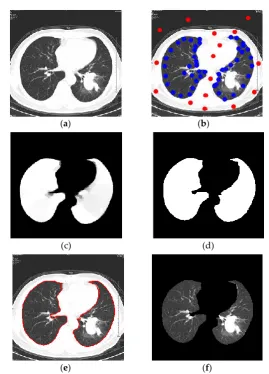 Fig. 2. This is pulmonary parenchymal segmentation process. (a) Original image; (b) Selection of seed point; (c) Calculation of foreground probability; (d) Binary segmentation results; (e) Segmentation boundary; (f) Segmentation result 
