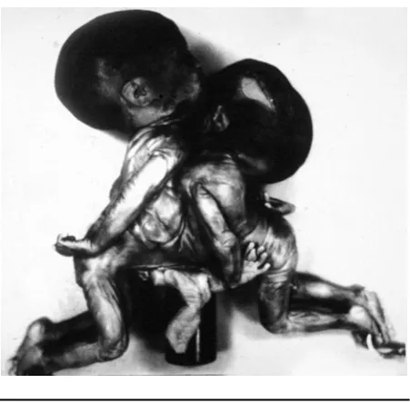 FIGURE 4Thoracopagus conjoined twins. Photo courtesy: Dr Hit Kishoreborn to King James I and his wife, Joan Beaufort, in 1430.Jacques is the future prince of Monaco