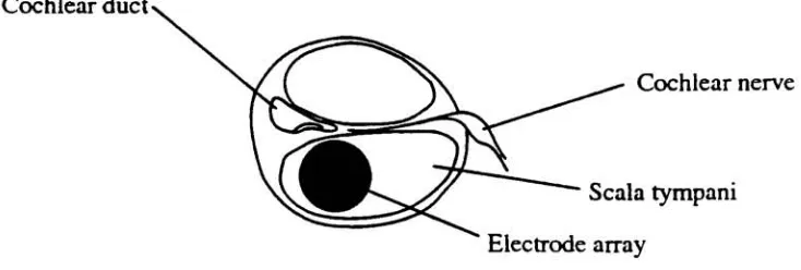 Figure 3. Position of electrode array within scala tympani