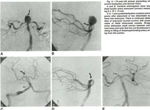 Fig. 4.-74-year-old woman presenting with severe headaches and blurred vision. 