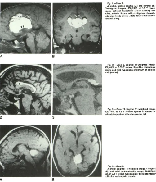 Fig. 1.-Case A 7. and 8 , Midline sagittal 