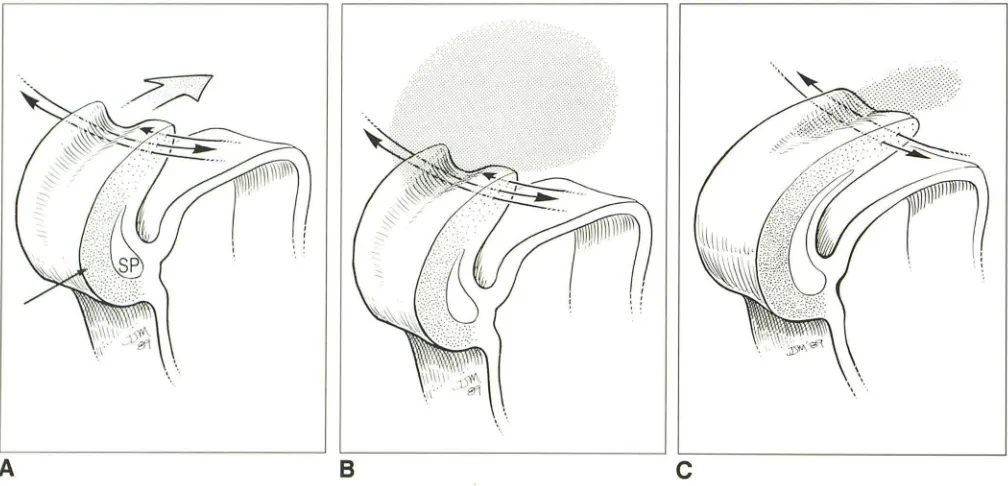 Fig. within future quadrigeminal/ superior cerebellar cistern. Note close proximity between) telencephalic vesicles and dorsal C, B, At stage In of lipomas into lateral ventricular choroid plexuses