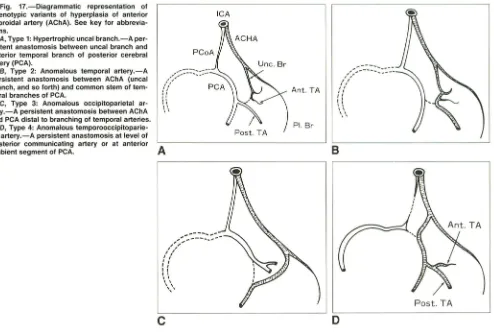 Fig. 17.-Diagrammatic phenotypic variants representation of of hyperplasia of anterior 