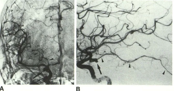Fig. 4.at origin of posterior communicating artery a(large straight choroidal artery (AChA) (type antAChA is so prominent that rrow) -Hypertrophic uncal branch of anterior 1)