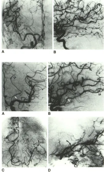 Fig. ?.-Anomalous A temporal artery (type . and 8, Anomalous artery courses far Ia