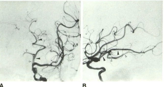 Fig. 9.-Anomalous temporooccipitoparietal artery (type 4). 
