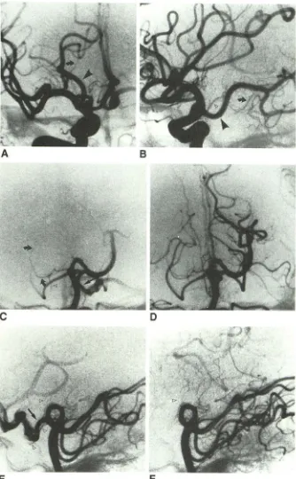 Fig. 10.-Anomalous rior choroidal artery (AChA) artery erroneously suggesting absence A temporooccipitoparietal of ante-(type 4)