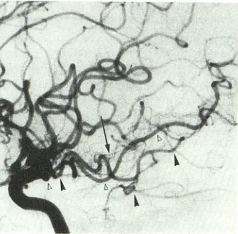 Fig. 12.-Well-developed ebral artery system branches, while well-developed PCoA-posterior cer-(type 2c)