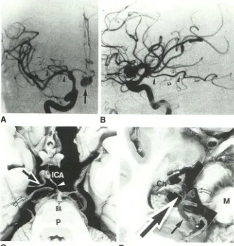 Fig. 14.-Anomalous artery (type 2c), con-firmed at autopsy. 
