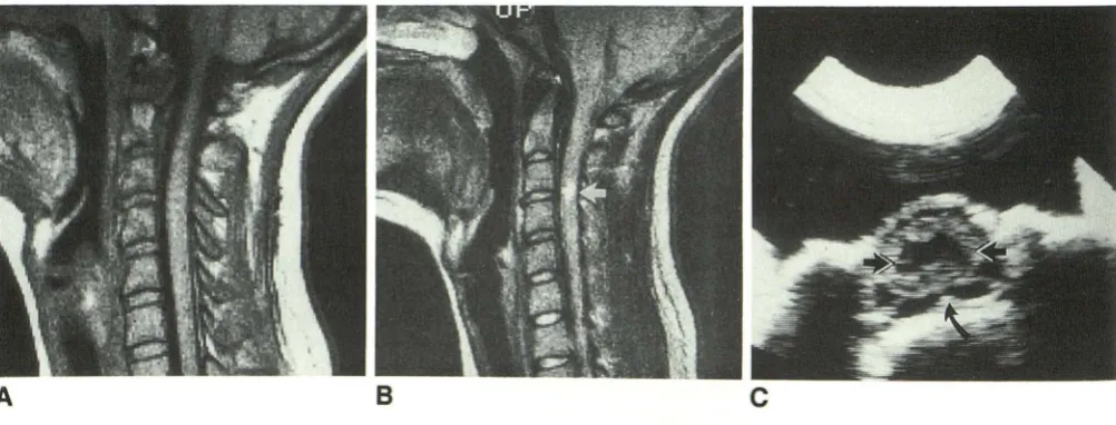 Fig. 1.arrows). T imaging. and lOSS. (Figs. 1A and contusion leSIOnRadiology examination C, 8 , in 23-year-old woman with quadriplegia Mid-lOSS 